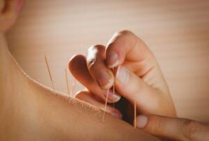 pic of a woman getting acupuncture: a natural remedy for menopause